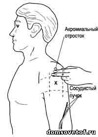 Колят плечи. Техника внутримышечной инъекции в дельтовидную мышцу. Укол внутримышечно в плечо схема. Техника внутримышечной инъекции в дельтовидную мышцу плеча. Техника введения внутримышечно в дельтовидную мышцу.